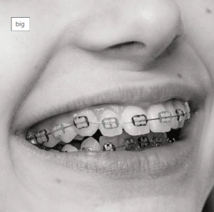 teeth-straightening-orthodontics-smile-nw-blog